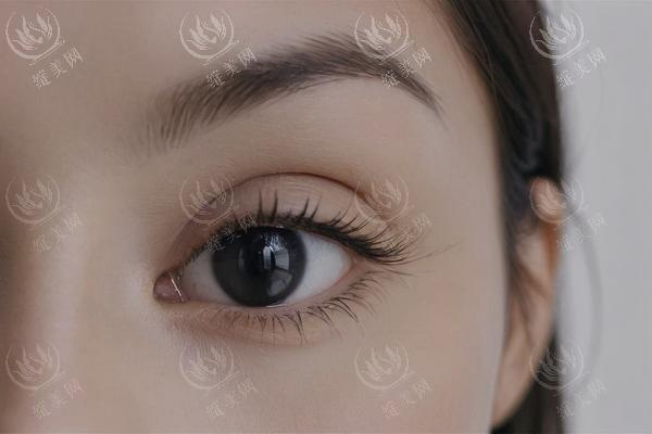 自体脂肪填充面部会变肿吗？复原期正常现象与加速消肿方法
