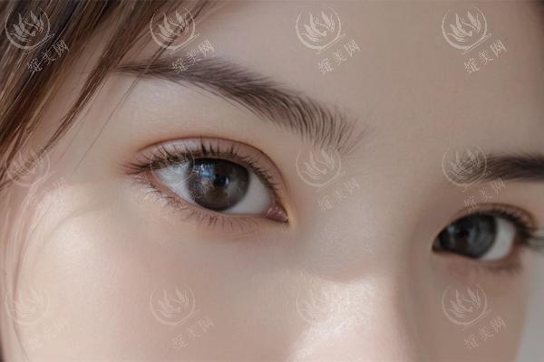 双眼皮手术全攻略：埋线、全切、三点定位怎么选？